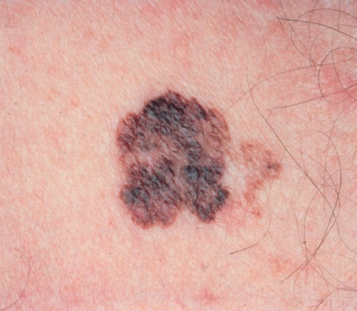 melanoma maligno de pele